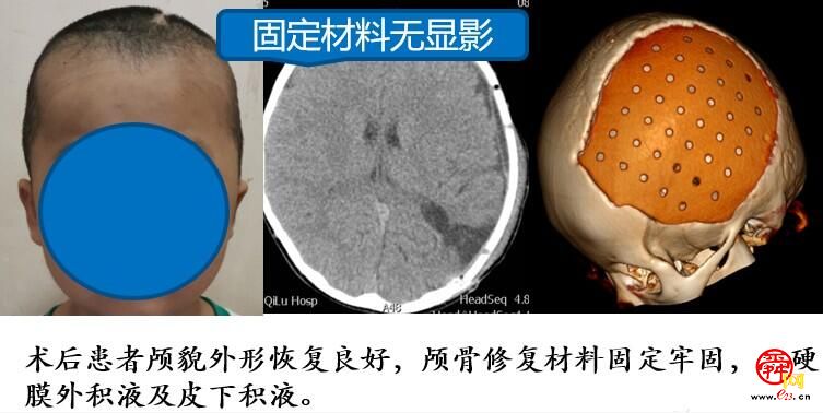 山东省首例山东大学齐鲁医院完成儿童颅骨缺损无金属化修补手术