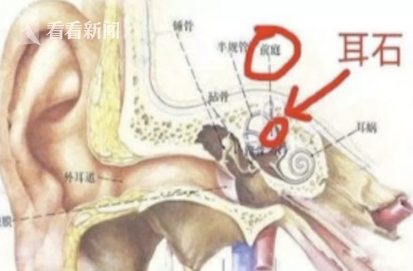 避免踩雷！用筋膜枪放松肌肉竟把自己打晕 耳朵里的“耳石”脱落