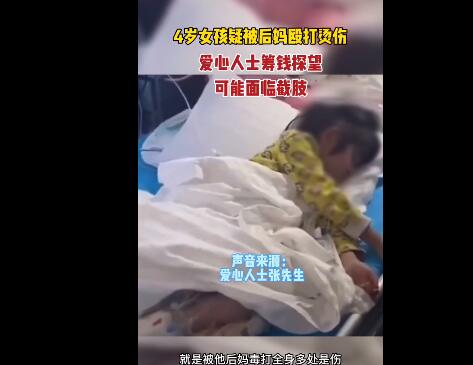 女童遭虐待双脚烧伤生父继母被刑拘 官方回应情况:病情较稳定