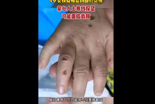 女童遭虐待双脚烧伤生父继母被刑拘 官方回应情况:病情较稳定