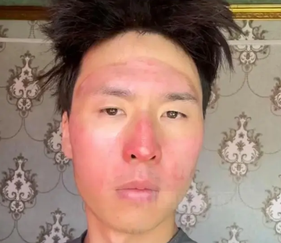 哭笑不得!男子爬雪山晒伤成面膜脸 一下从帅哥晒成师傅了