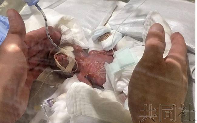 震惊了!世界最小男婴体重仅有268克 怎么活下来了?